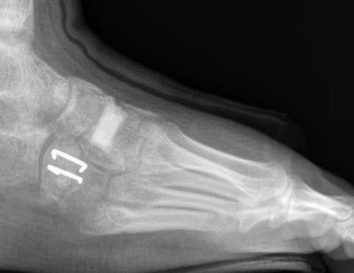 Metatarsus adductus