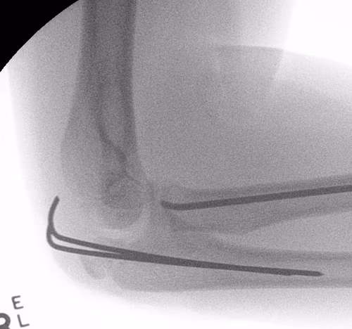 Radial neck olecranon