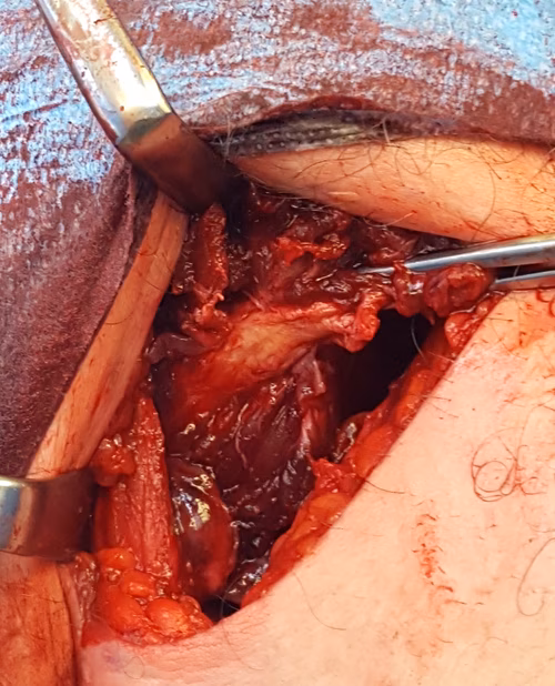 Pec major repair 1