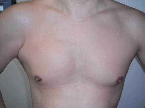 Pec Major Rupture