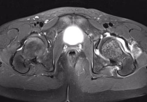 Septic arthritis