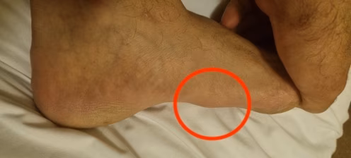 Fibroma