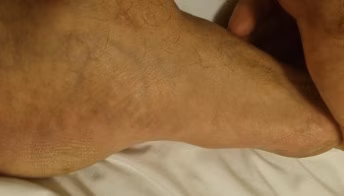 fibroma