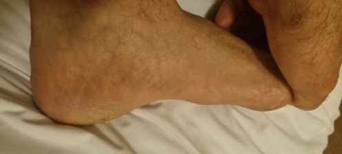 Fibroma