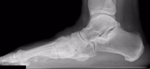 Midfoot OA