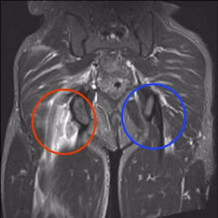 Prox hs tear MRI