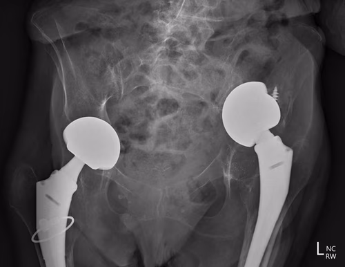 Intrapelvic acetab