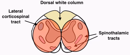 Anterior cord syndrome