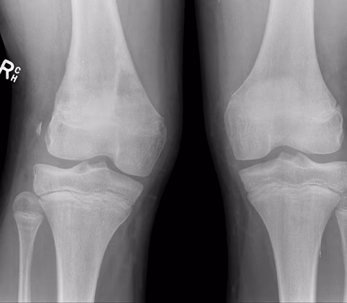 angular deformity