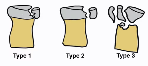 Mason Classification