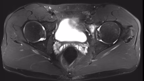 Acetabular version 1