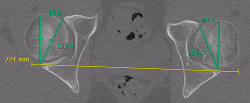 Acetabular version