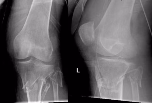 Proximal tibia #