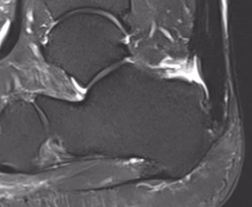 Insertional