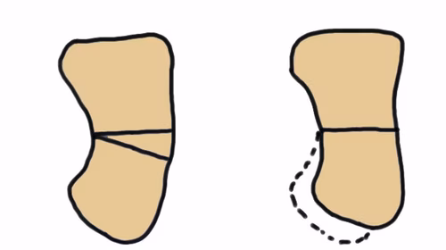 Dwyer calc osteotomy