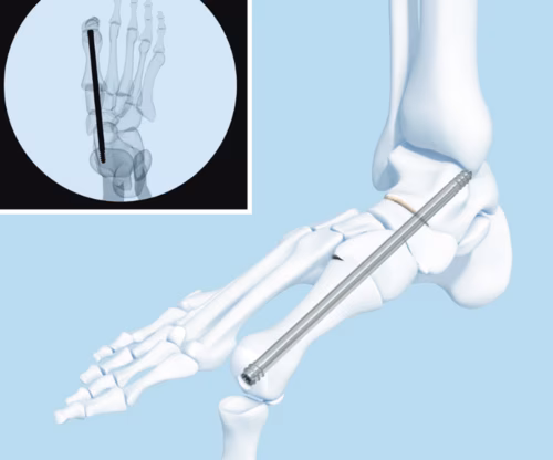 Midfoot fusion bolt