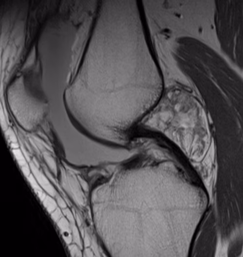 lipoma
