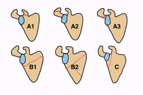 Scapula fractures