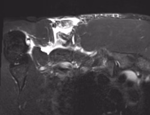 Pec tear