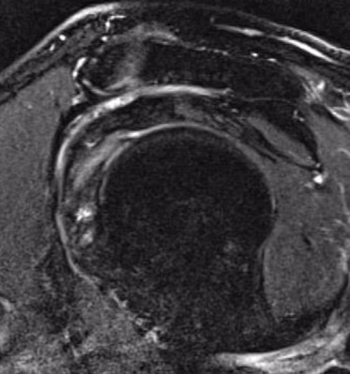 LHB tendinopathy