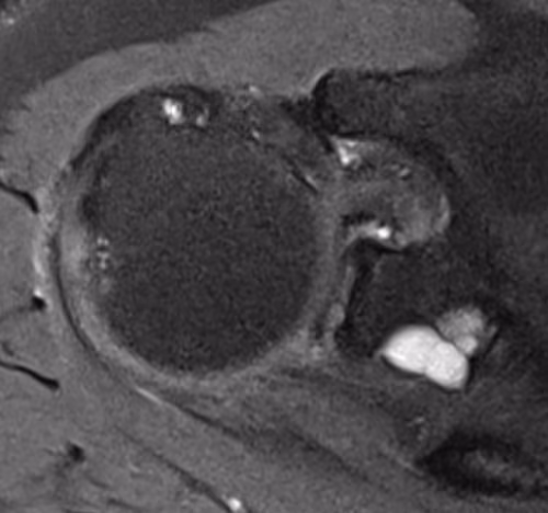 cyst