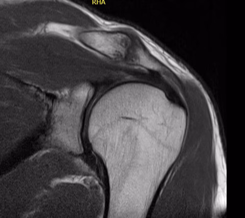 osteolysis