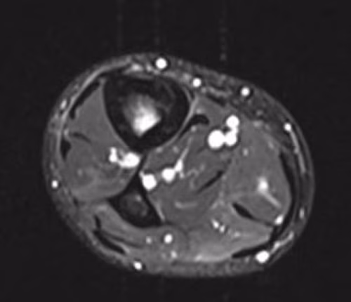 MRI tibia stress