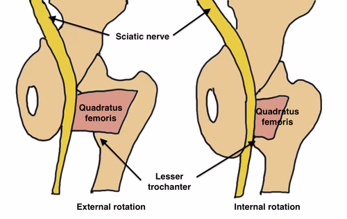 Ischiofemoral impingement