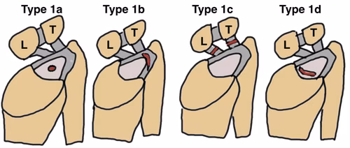 TFCC