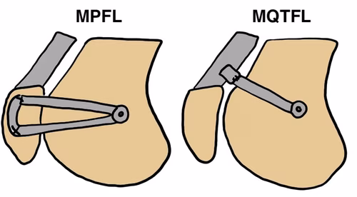 MPFL MQTFL