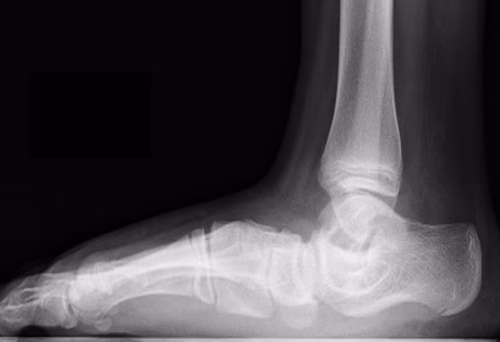 Skewfoot