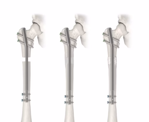 Precice femoral nail