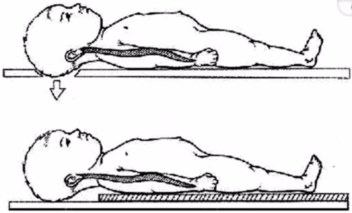 Immobilization