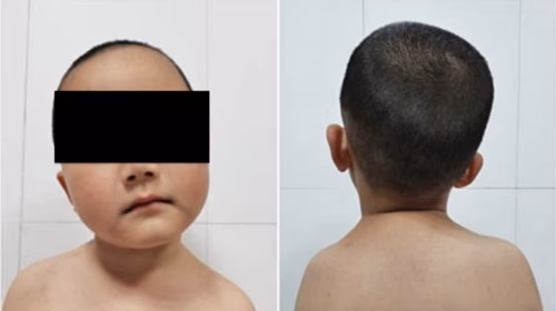 Torticollis