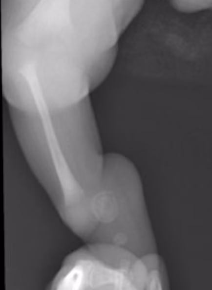 tibia hemimelia