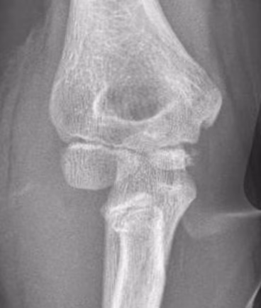 radial neck fracture