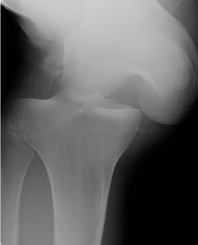 knee dis