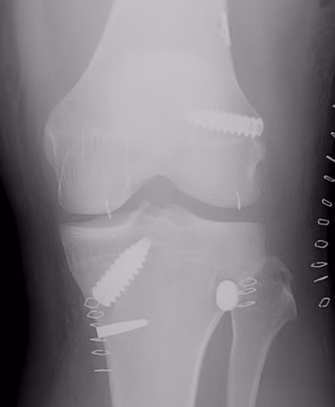 knee dislocation