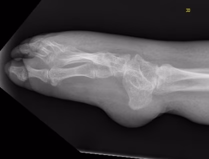 Spina bifida 