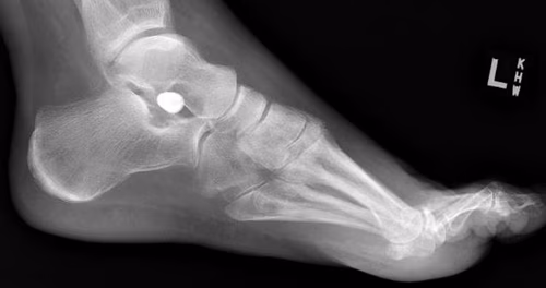 implant