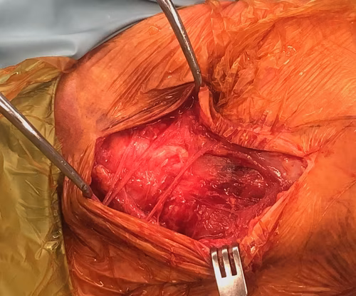 supraclav nerves