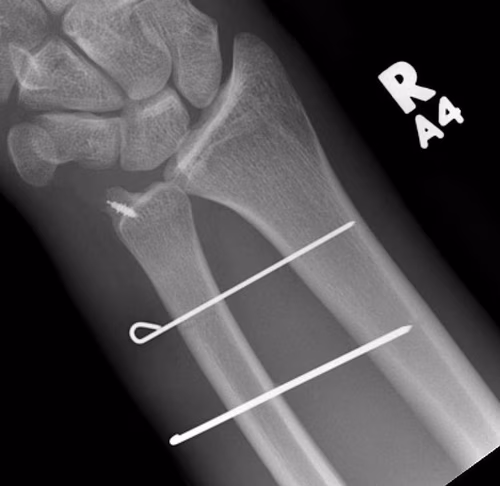 TFCC repair