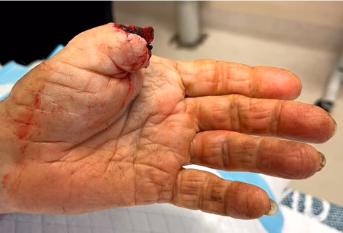 Thumb 1