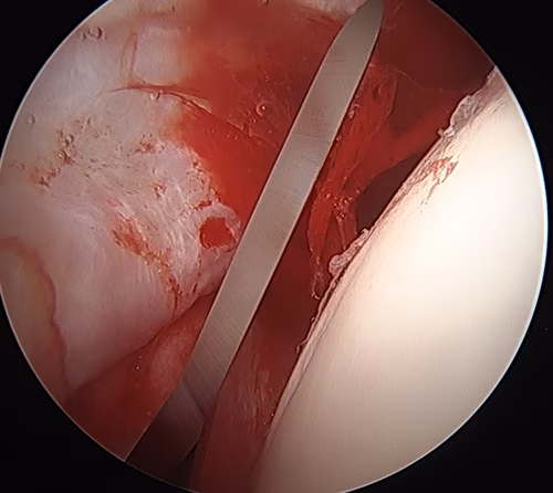 Interportal capsulotomy 1