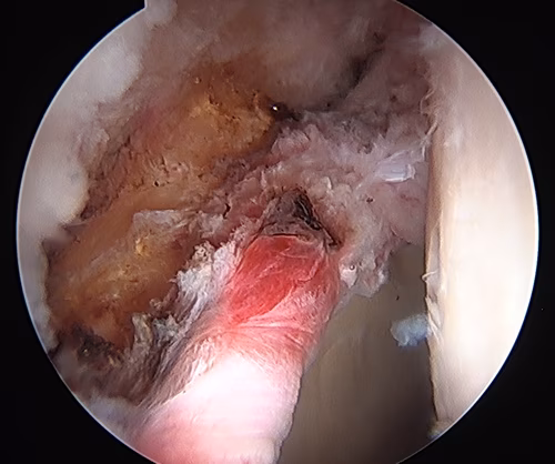 Acetabulum 2