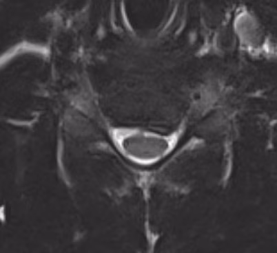 Cervical disc MRI
