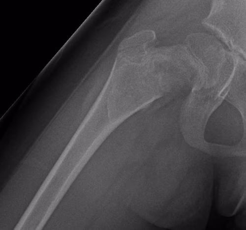 FD femur 3