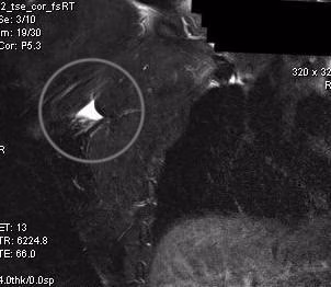 MRI Pec major tear 2