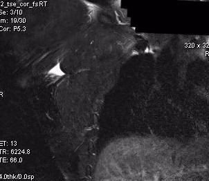 MRI P Major tear 1