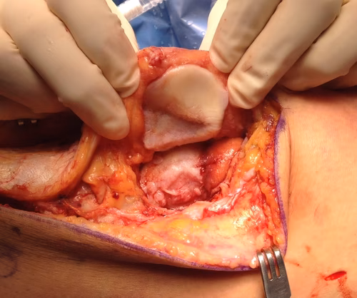Patella instability cartilage loss